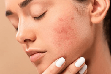 best-toners-for-acne-prone-skin